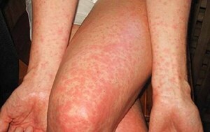 Alertan de inusual brote de chikungunya y dengue en invierno – Prensa 5