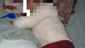 Niño de 4 años se quemó con agua hervida y necesita ayuda