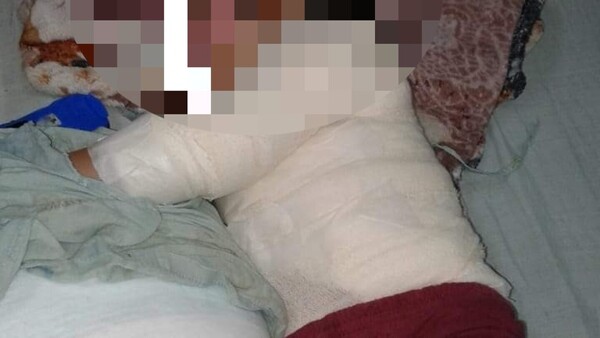 Niño de 4 años se quemó con agua hervida y necesita ayuda