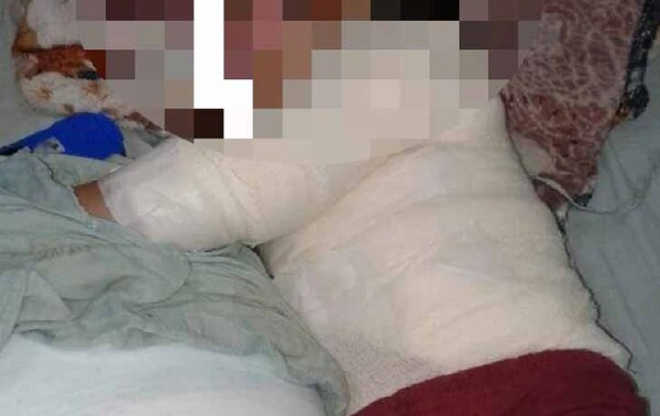 Niño de 4 años se quemó con agua hervida y necesita ayuda – Prensa 5