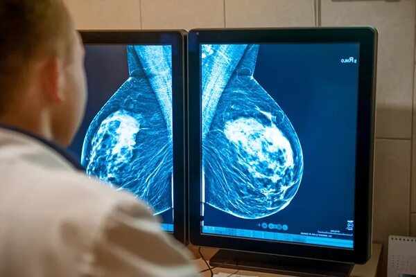Inteligencia artificial podría detectar cáncer de mama precoz - Ciencia - ABC Color