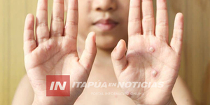 CASOS POSITIVOS DE VARICELA PREOCUPAN A INSTITUCIONES EDUCATIVAS - Itapúa Noticias