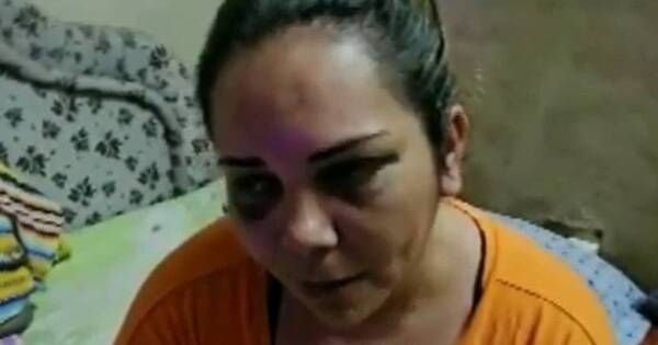 La Nación / Mujer denuncia violencia extrema: su expareja le habría desfigurado el rostro