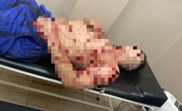 Joven fue agredido por su pareja con una botella de vidrio rota