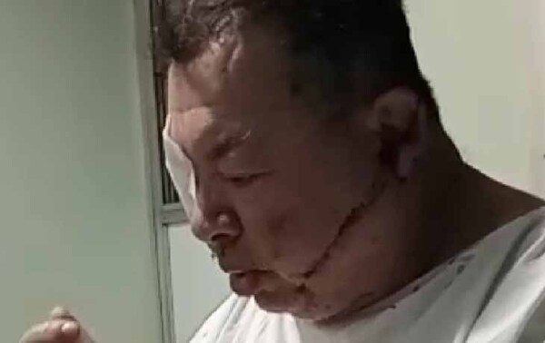 Guardia atacado a machetazos en Pedro Juan Caballero perdió la vista en uno de sus ojos – Prensa 5