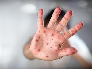 La OMS confirmó mas de 1.000 casos de viruela del mono | OnLivePy