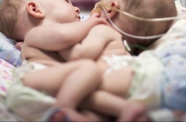 Confirman fallecimiento del bebé siamés en Clínicas: “ya no toleró todo el proceso” - trece