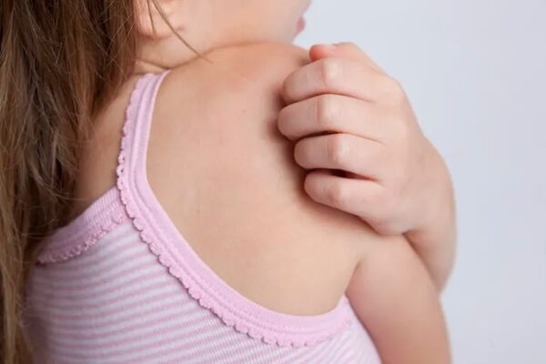 Picaduras de insectos a niños: el ABC de la prevención y el tratamiento - Estilo de vida - ABC Color