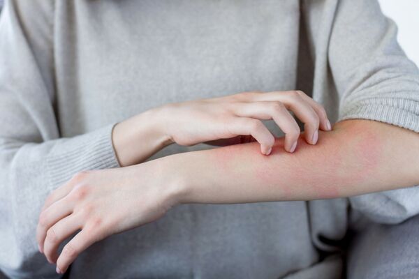 Diario HOY | Dermatitis atópica: nuevos tratamientos brindan una luz de esperanza