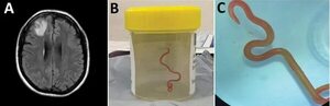 Australia: Extraen del cerebro de una mujer una lombriz intestinal viva de 8 centímetros - Mundo - ABC Color