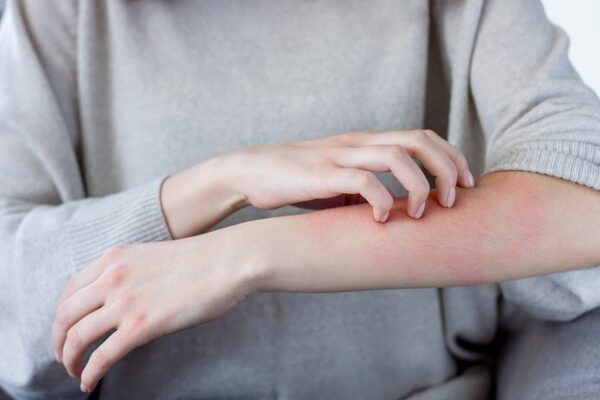 Dermatitis atópica: nuevos abordajes médicos para una molestia persistente - El Independiente
