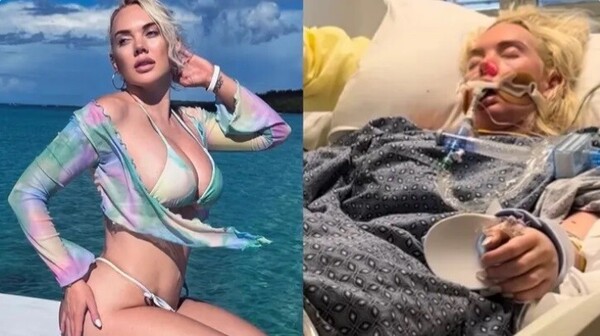 Amputan pierna a una modelo de 33 años tras sufrir infección de bacteria come carne
