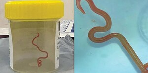 Miedo: Extraen una lombriz viva del cerebro de una mujer - Noticiero Paraguay
