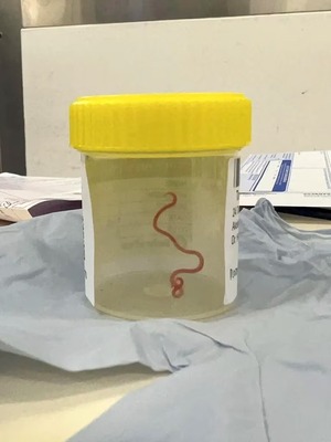 Australia: médicos extraen un gusano vivo del cerebro de una mujer - Unicanal