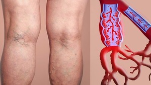 Diario HOY | ¿Qué tipo de sangre tiene mayor riesgo de desarrollar coágulos en las piernas?