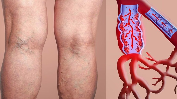 Diario HOY | ¿Qué tipo de sangre tiene mayor riesgo de desarrollar coágulos en las piernas?