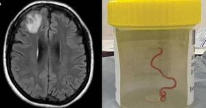 La Nación / Retiran lombriz de 8 centímetros del cerebro de una mujer