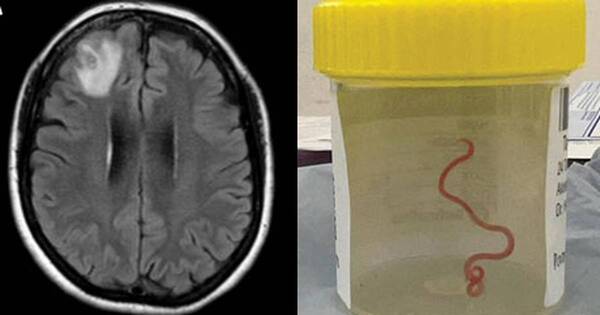 La Nación / Retiran lombriz de 8 centímetros del cerebro de una mujer