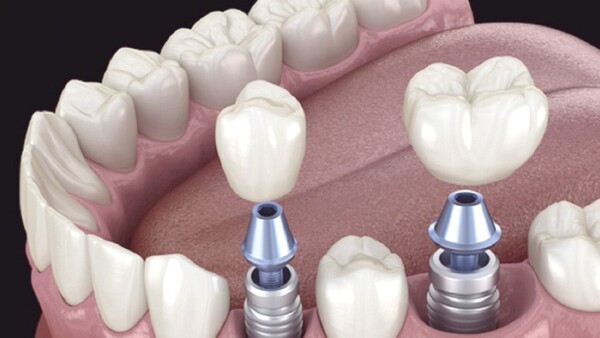 Alertan sobre implantes truchos y de contrabando