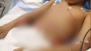 Niño se quemó el cuerpo al hacer reto viral de TikTok