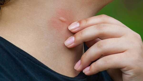 Confirman malaria en joven que vive en Foz de Yguazú y estudia en CDE - La Clave