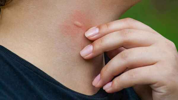 Confirman malaria en joven que vive en Foz de Yguazú y estudia en CDE