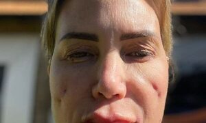 Ministerio de Salud anuncia suspensión de PMMA en nuestro país