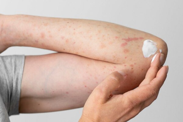 Diario HOY | Dermatitis atópica: más que un picor de la piel, afecta también el cuerpo y la mente