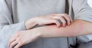La Nación / Día Mundial de la Dermatitis Atópica: “mucho más que un prurito”