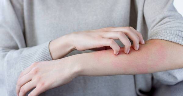 La Nación / Día Mundial de la Dermatitis Atópica: “mucho más que un prurito”