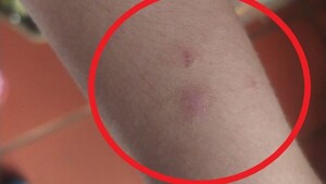 Niña denunció que su profe le arañó y le pinchó en el brazo