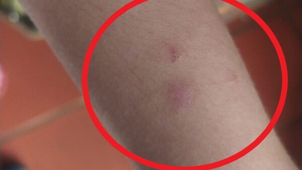 Niña denunció que su profe le arañó y le pinchó en el brazo