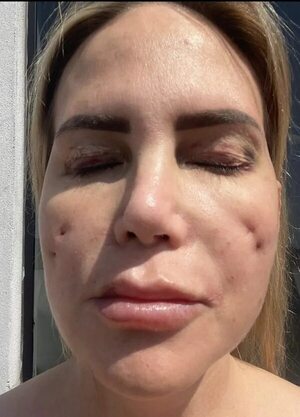 AUDIO: Doctoras Barbie: “Nosotros sostenemos que sí se le inyectó una mezcla de ácido hialurónico y el PMMA”, dice abogado de víctima de presunta mala praxis - La Primera Mañana - ABC Color