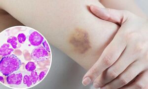 Recuerdan el día mundial de la Leucemia Mieloide Crónica