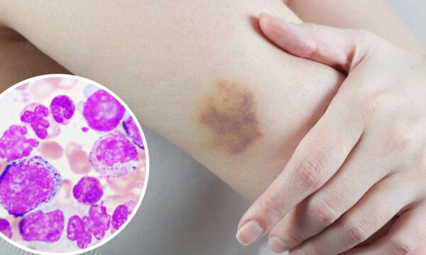Recuerdan el día mundial de la Leucemia Mieloide Crónica