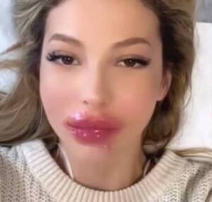 [VIDEO] Influencer se inyectó algo en los labios y el resultado fue de terror