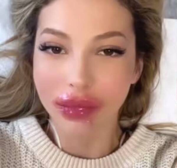 [VIDEO] Influencer se inyectó algo en los labios y el resultado fue de terror