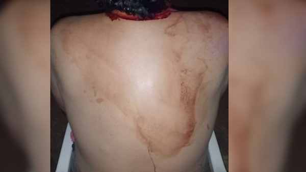 Mujer hiere a su pareja con un martillo tras discusión