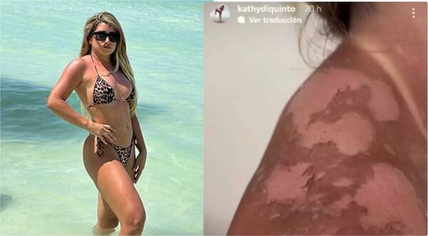 [VIDEO] Esta cantante mostró la grave quemazón que tuvo en sus vacaciones