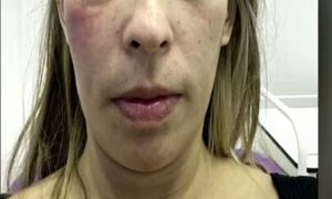 Yiyi denuncia mala praxis de odontóloga que le aplicó silicona
