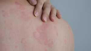 Estos alimentos podrían provocarte urticaria - Gastronomía - ABC Color