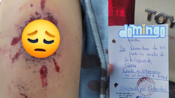 Menor quedó con quemaduras de tercer grado tras explosión de petardos