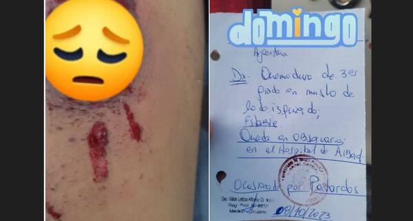 ¡Qué bárbaro! Adolescente fue a la cancha y la quemaron con petardos