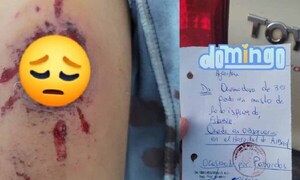 Menor quedó con quemaduras de tercer grado tras explosión de petardos en Ñeembucú – Prensa 5