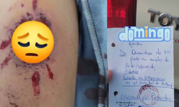 Menor quedó con quemaduras de tercer grado tras explosión de petardos en Ñeembucú – Prensa 5