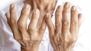 Exponen arsenal de tratamientos innovadores de la artritis reumatoidea y alertan sobre efectos perniciosos en la calidad de vida – La Mira Digital