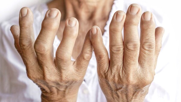 Exponen arsenal de tratamientos innovadores de la artritis reumatoidea y alertan sobre efectos perniciosos en la calidad de vida – La Mira Digital