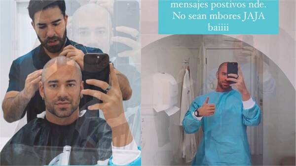 ¡Renato Prono tuvo una cirugía de implante de cabello!