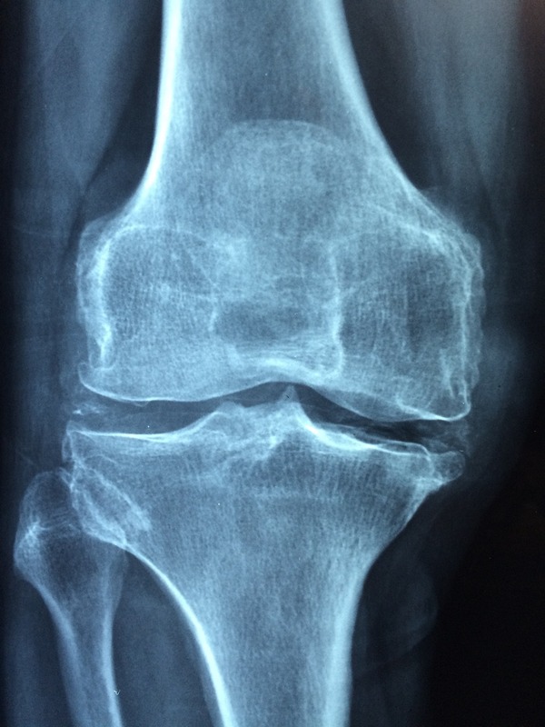 Mujeres post menopausia tienen mayor riesgo de fracturas, advierte especialista » San Lorenzo PY