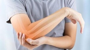 Diario HOY | Mujeres post menopausia son más propensas a fracturas, alertan